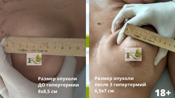 опухоль в груди
