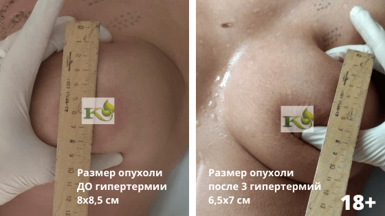 опухоль в груди 2